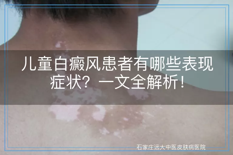 儿童白癜风患者有哪些表现症状？一文全解析！