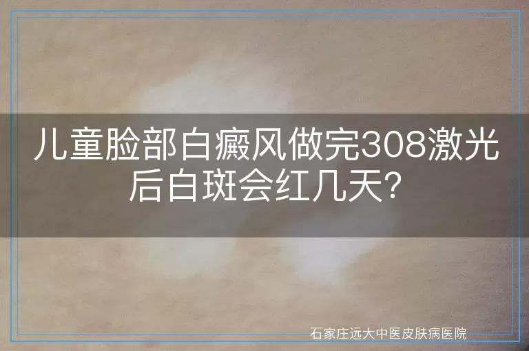 儿童脸部白癜风做完308激光后白斑会红几天？