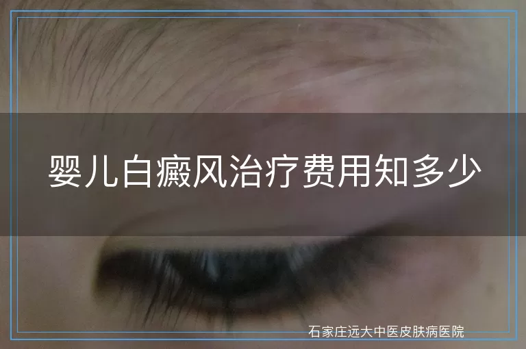 婴儿白癜风治疗费用知多少
