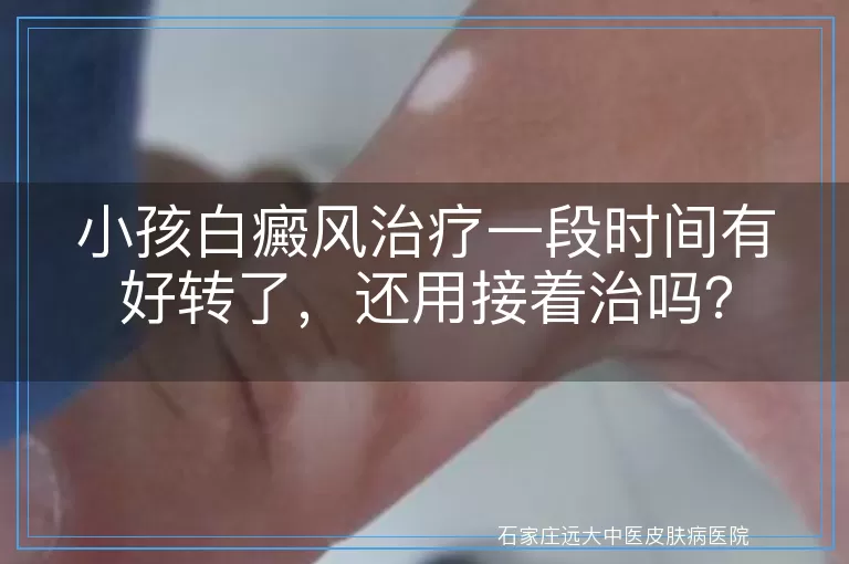 小孩白癜风治疗一段时间有好转了，还用接着治吗？