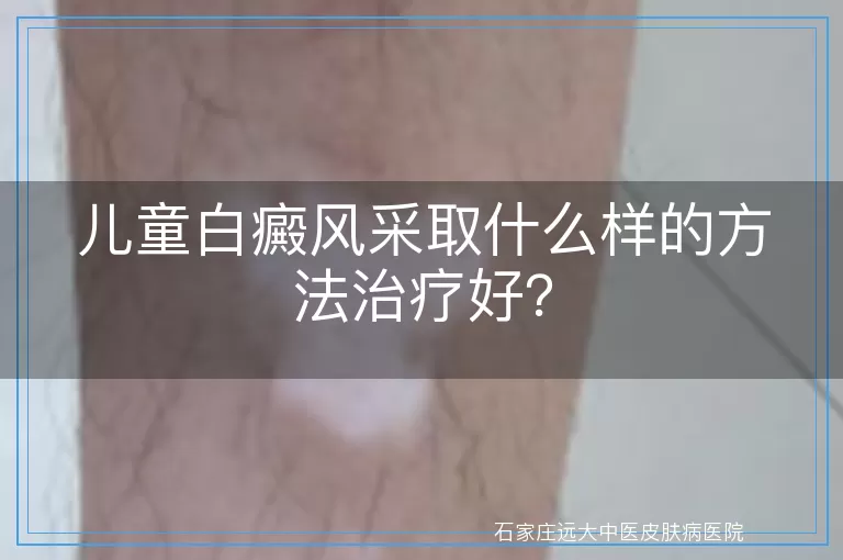儿童白癜风采取什么样的方法治疗好？