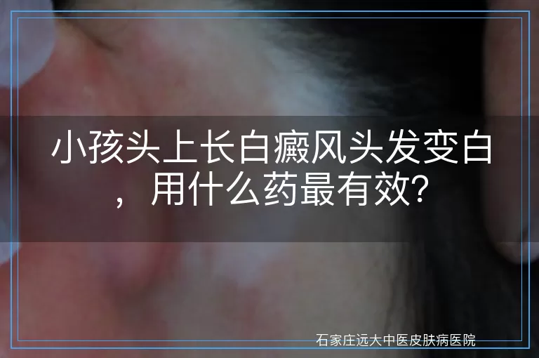 小孩头上长白癜风头发变白，用什么药最有效？