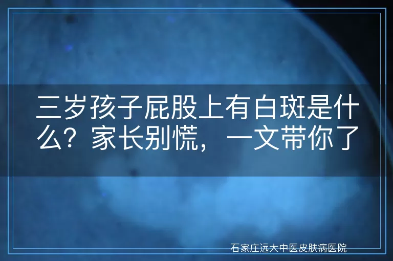 三岁孩子屁股上有白斑是什么？家长别慌，一文带你了解！