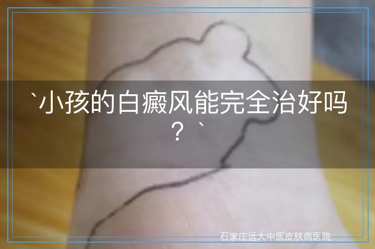 小孩的白癜风能完全治好吗？
