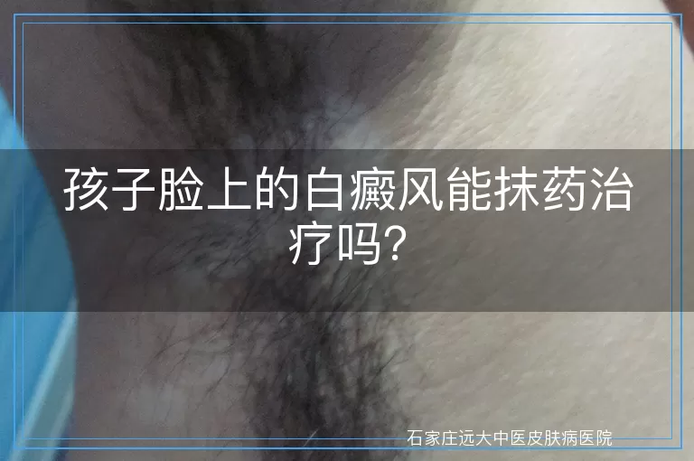孩子脸上的白癜风能抹药治疗吗？