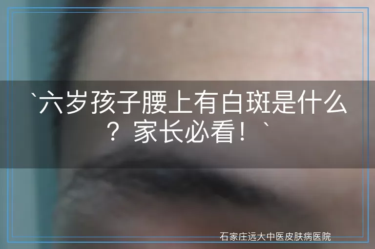 六岁孩子腰上有白斑是什么？家长必看！