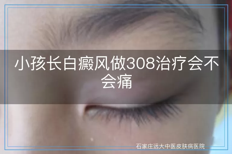 小孩长白癜风做308治疗会不会痛