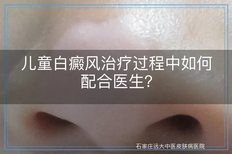 儿童白癜风治疗过程中如何配合医生？