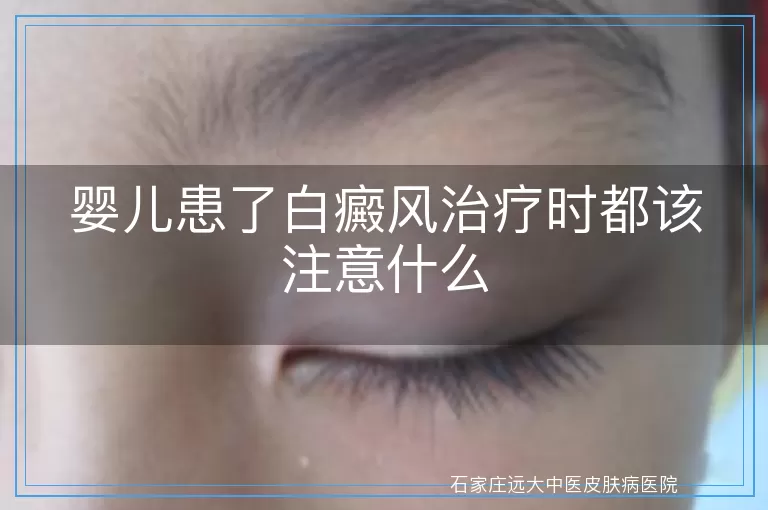 婴儿患了白癜风治疗时都该注意什么