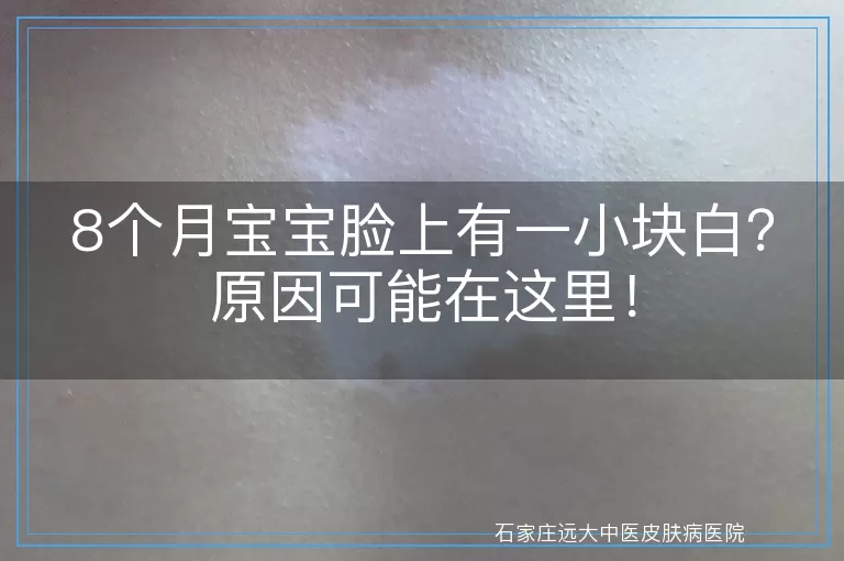 8个月宝宝脸上有一小块白？原因可能在这里！