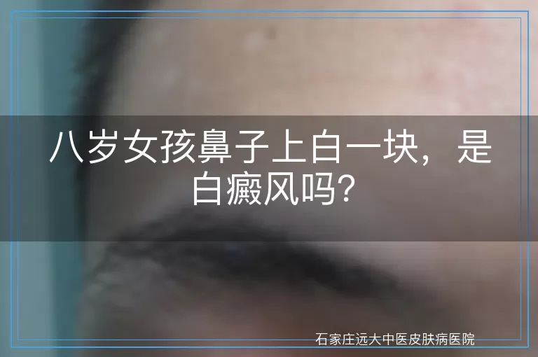 八岁女孩鼻子上白一块，是白癜风吗？