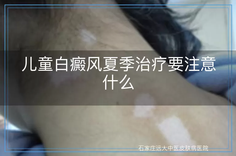 儿童白癜风夏季治疗要注意什么