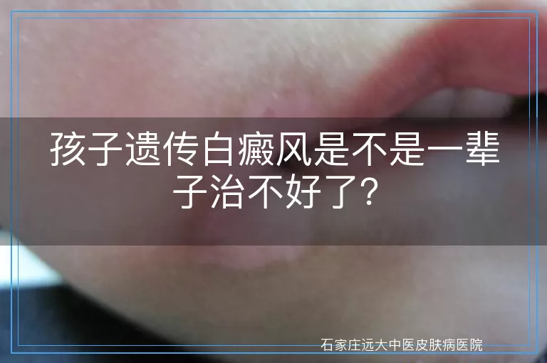 孩子遗传白癜风是不是一辈子治不好了？
