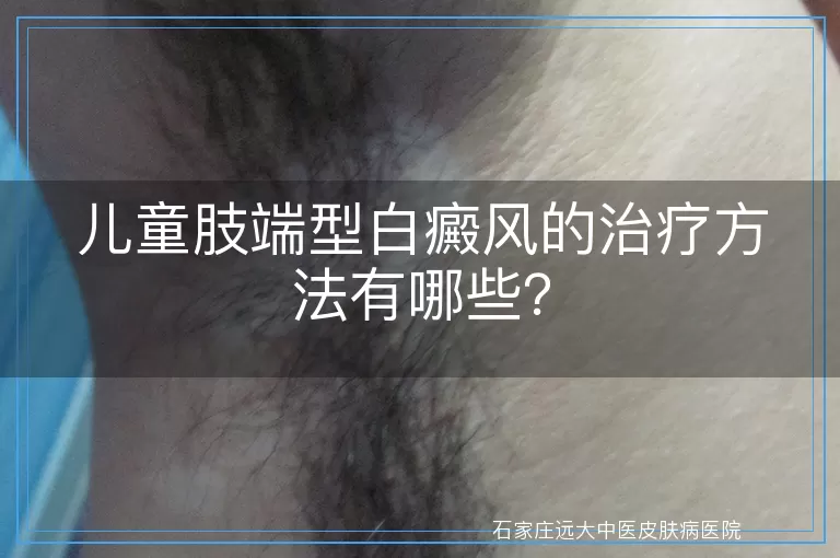 儿童肢端型白癜风的治疗方法有哪些？