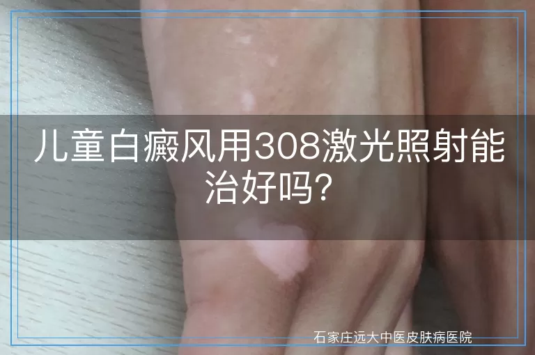 儿童白癜风用308激光照射能治好吗？