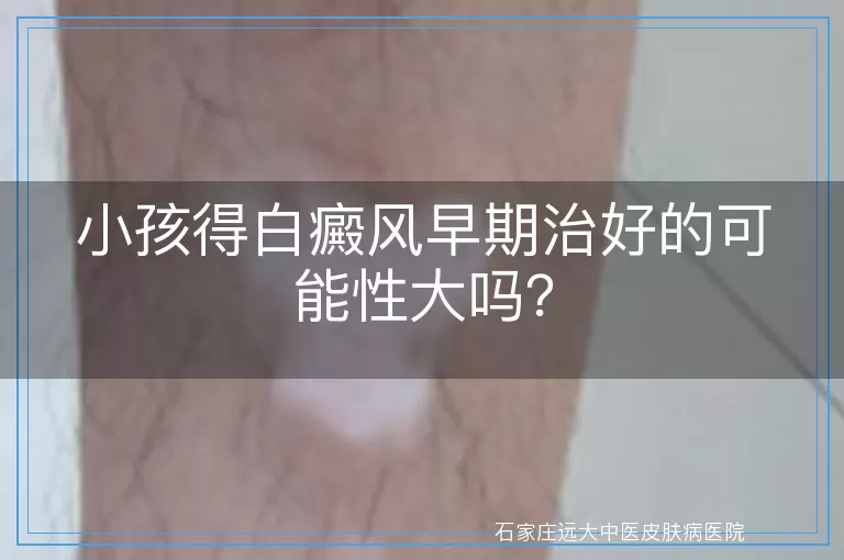 小孩得白癜风早期治好的可能性大吗？