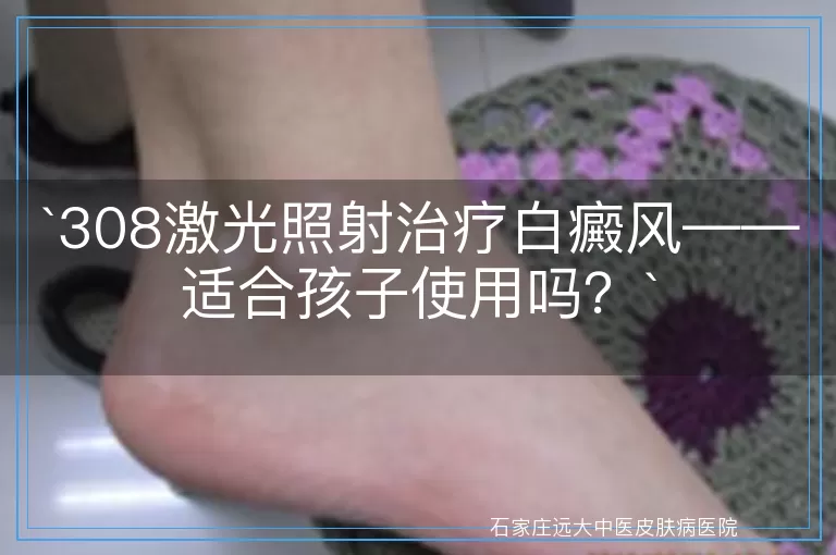 308激光照射治疗白癜风——适合孩子使用吗？
