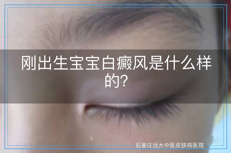刚出生宝宝白癜风是什么样的？