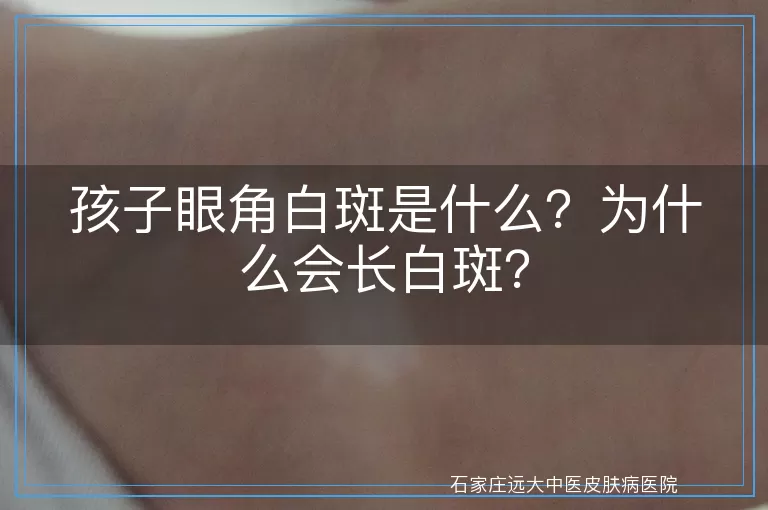 孩子眼角白斑是什么？为什么会长白斑？