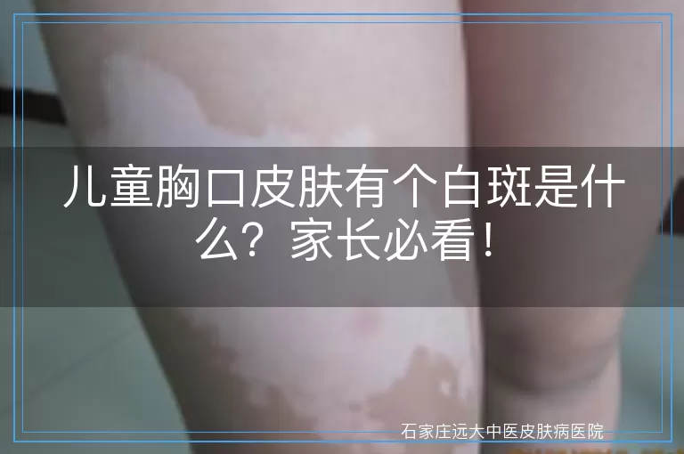 儿童胸口皮肤有个白斑是什么？家长必看！