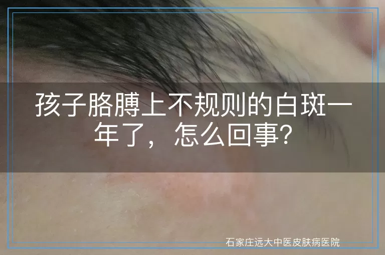 孩子胳膊上不规则的白斑一年了，怎么回事？