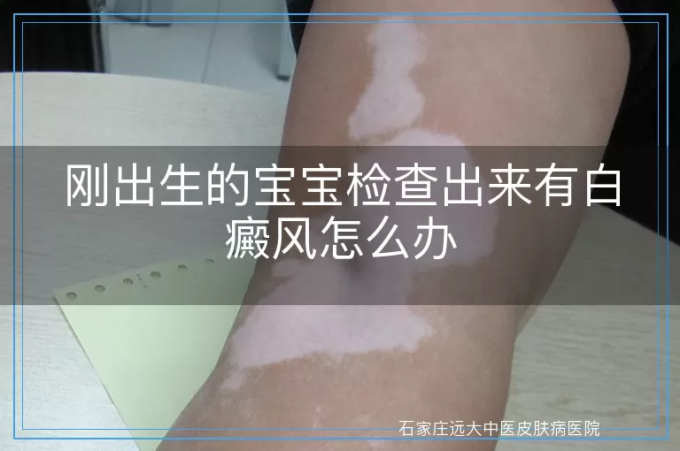 刚出生的宝宝检查出来有白癜风怎么办