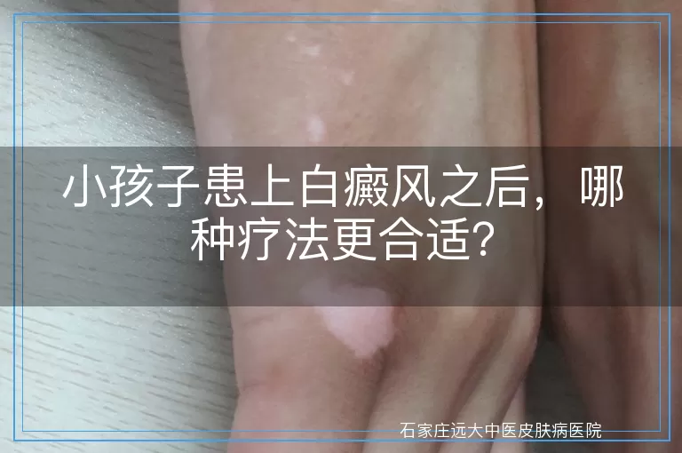 小孩子患上白癜风之后，哪种疗法更合适？