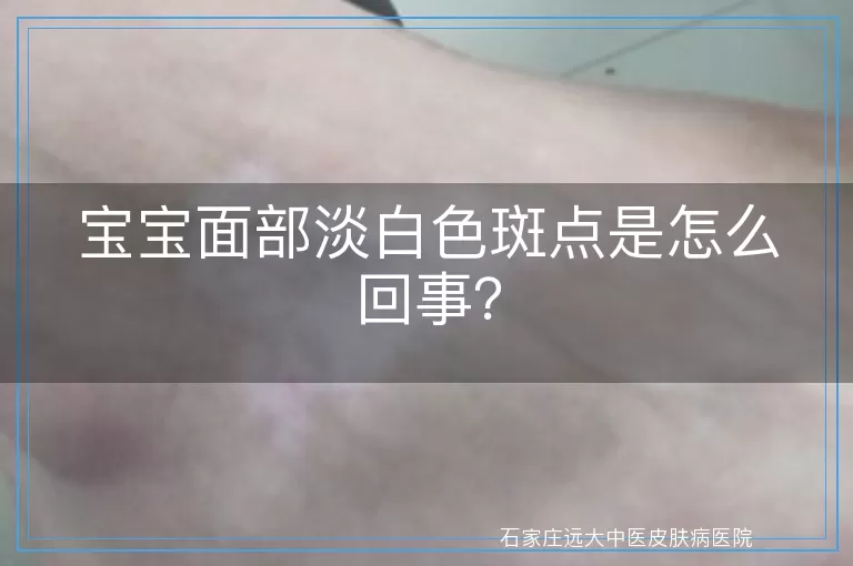 宝宝面部淡白色斑点是怎么回事？