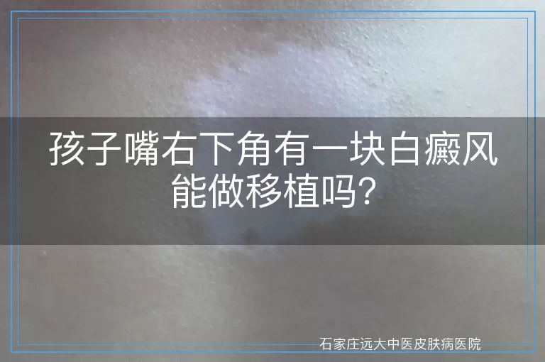 孩子嘴右下角有一块白癜风能做移植吗？