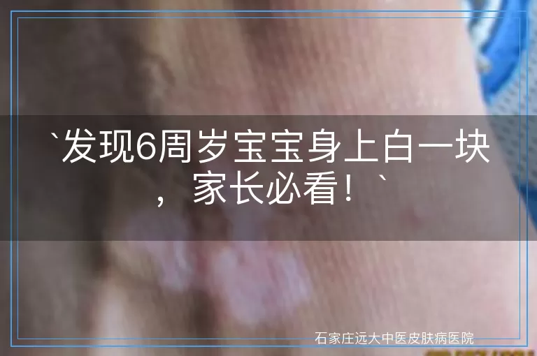 发现6周岁宝宝身上白一块，家长必看！