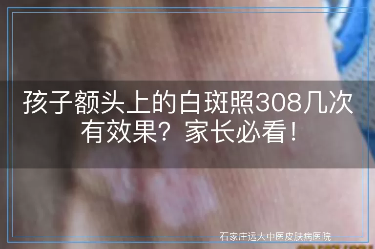 孩子额头上的白斑照308几次有效果？家长必看！