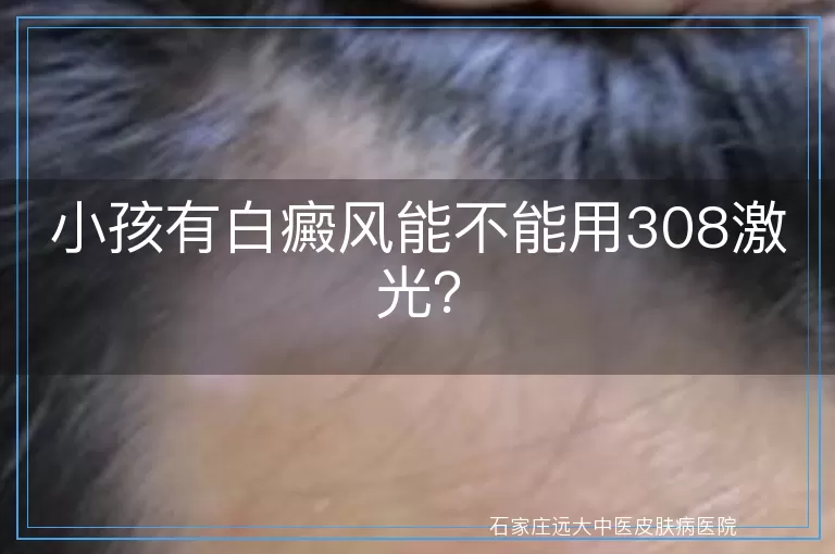 小孩有白癜风能不能用308激光？