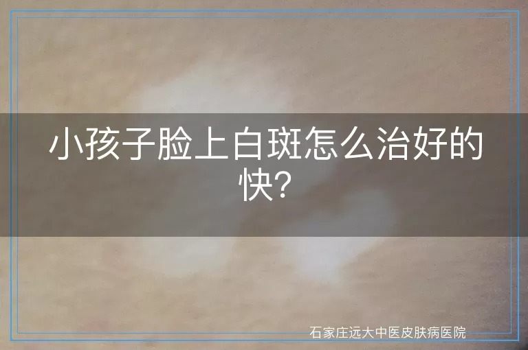 小孩子脸上白斑怎么治好的快？
