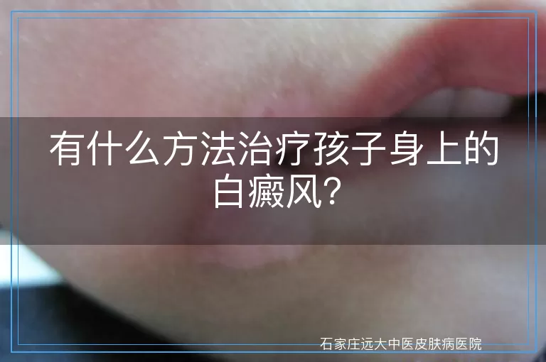 有什么方法治疗孩子身上的白癜风？