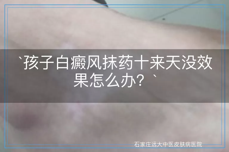孩子白癜风抹药十来天没效果怎么办？