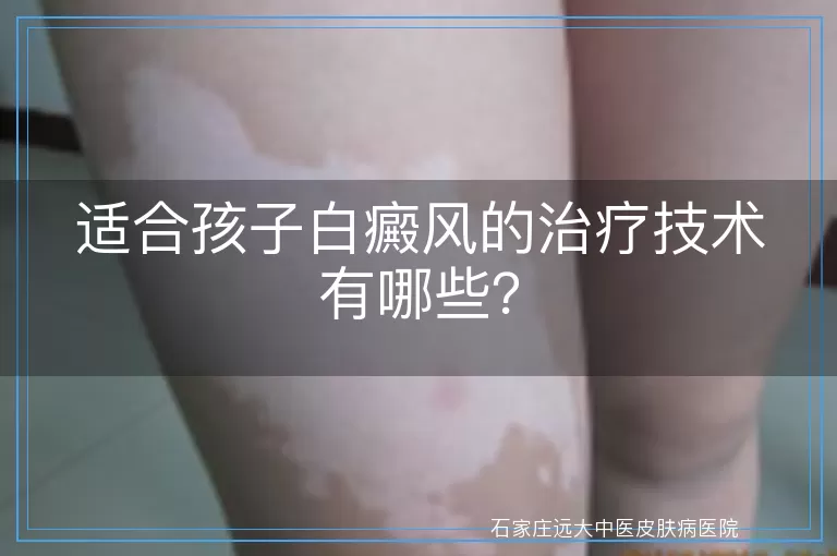 适合孩子白癜风的治疗技术有哪些？