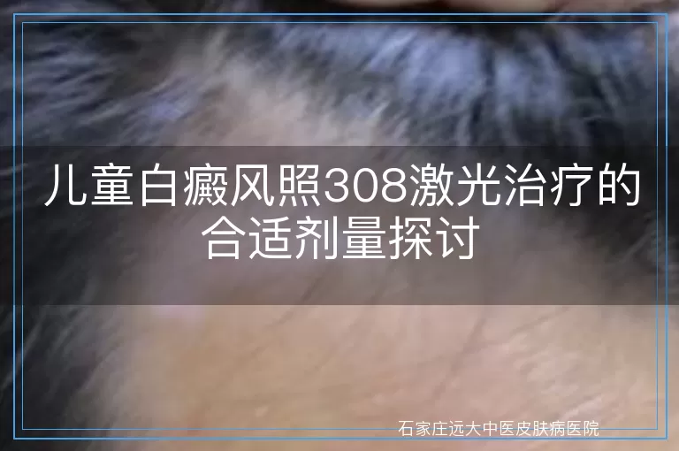 儿童白癜风照308激光治疗的合适剂量探讨