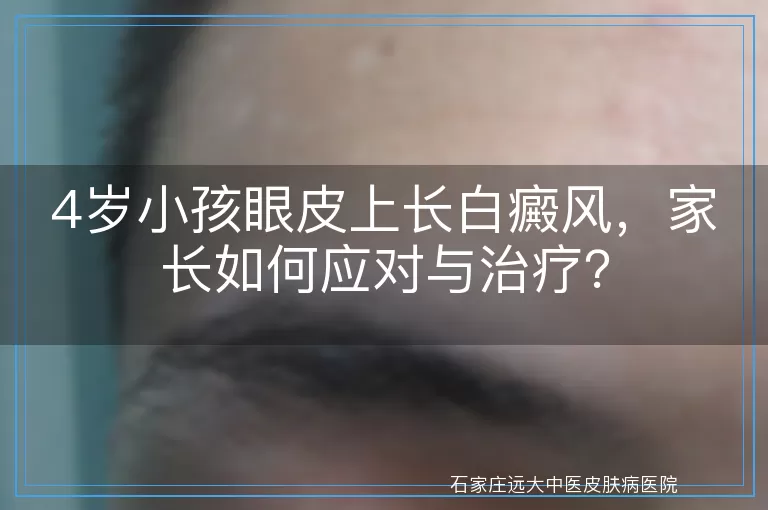 4岁小孩眼皮上长白癜风，家长如何应对与治疗？