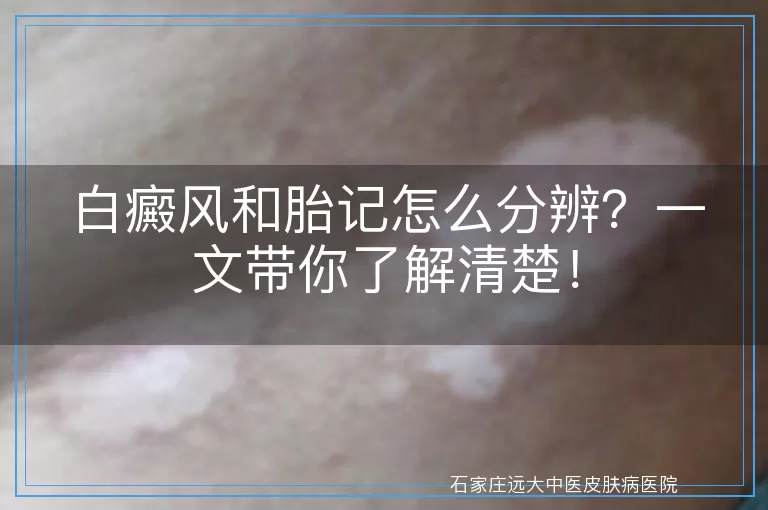 白癜风和胎记怎么分辨？一文带你了解清楚！