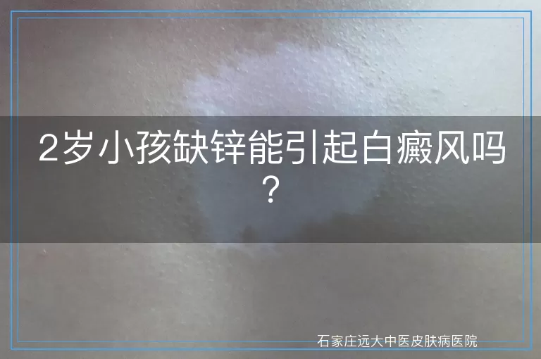 2岁小孩缺锌能引起白癜风吗？