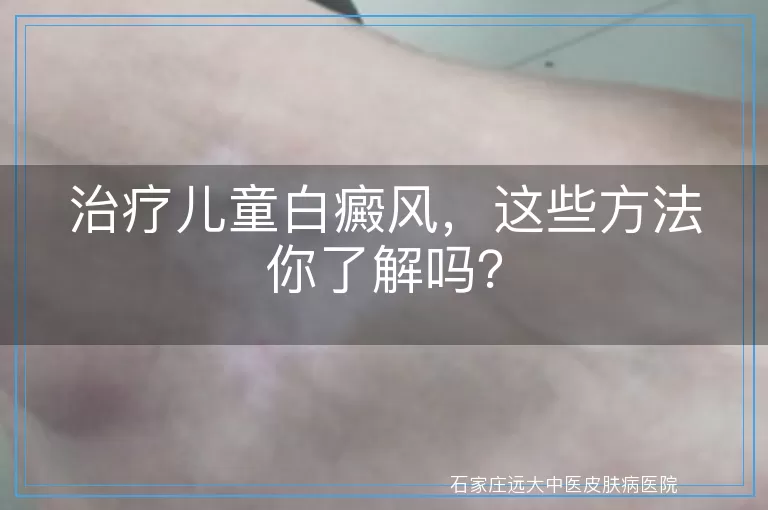 治疗儿童白癜风，这些方法你了解吗？