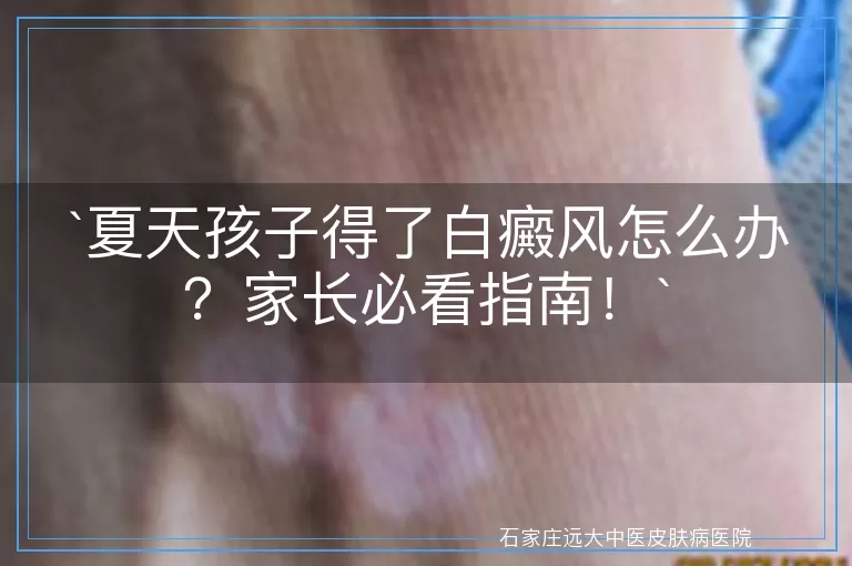 夏天孩子得了白癜风怎么办？家长必看指南！