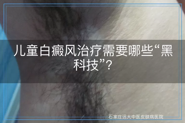 儿童白癜风治疗需要哪些“黑科技”？