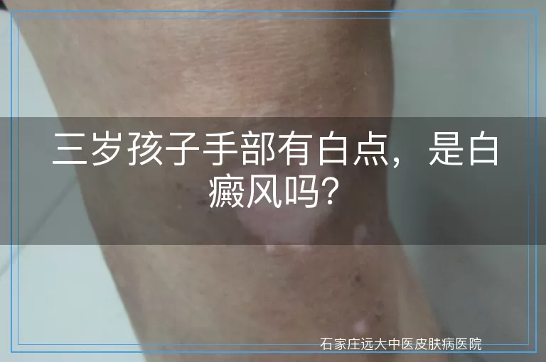 三岁孩子手部有白点，是白癜风吗？