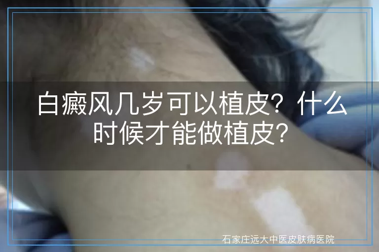 白癜风几岁可以植皮？什么时候才能做植皮？