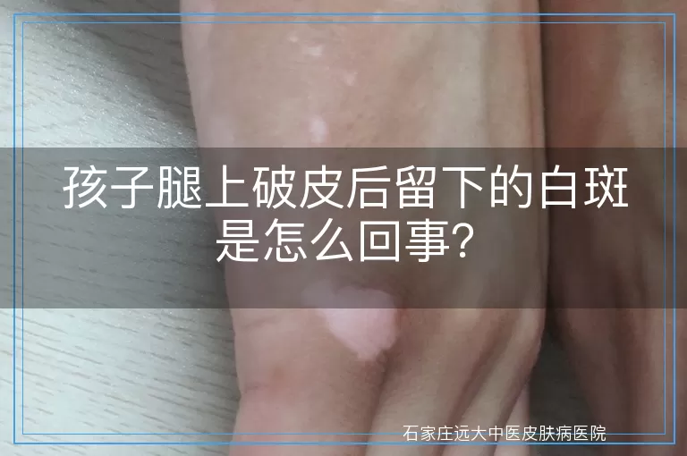 孩子腿上破皮后留下的白斑是怎么回事？