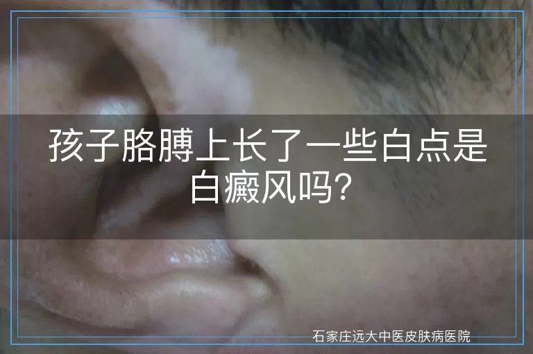 孩子胳膊上长了一些白点是白癜风吗？