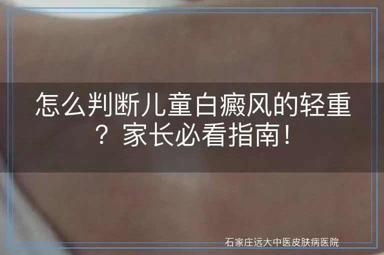 怎么判断儿童白癜风的轻重？家长必看指南！