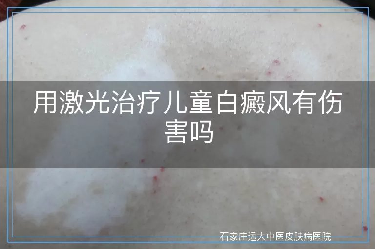 用激光治疗儿童白癜风有伤害吗