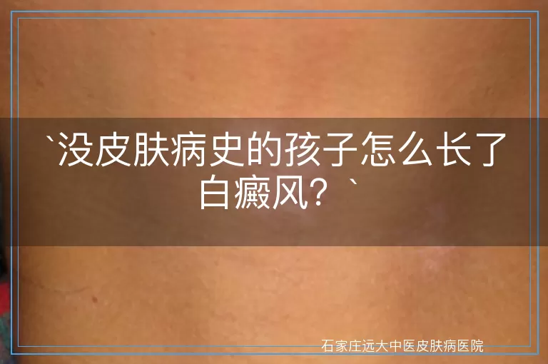 没皮肤病史的孩子怎么长了白癜风？